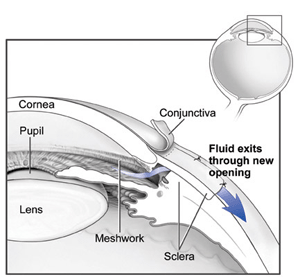 Glaucoma after surgery