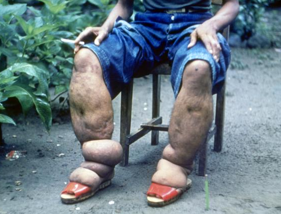 Elephantiasis of leg due to filariasis. Luzon, Philippines.