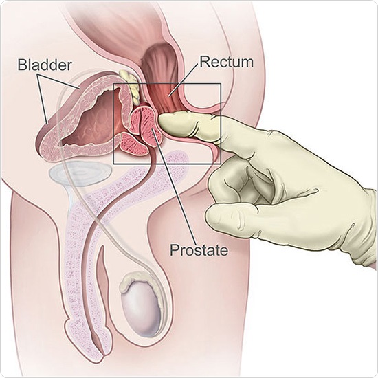 Rectal examination of the prostate