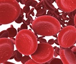 Intravenous iron shows safe and beneficial outcomes for patients with bacterial infection and anemia