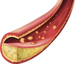 Statins reduce patient's risk of developing Barrett's esophagus