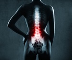 UC research could lead to possible treatments for scoliosis in the future