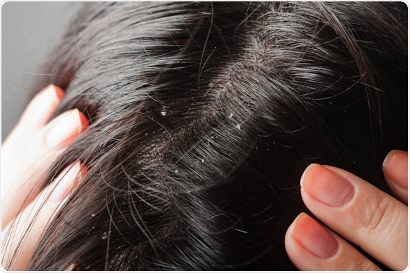 Dandruff