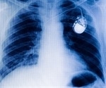 Experimental wireless pacemaker harvests energy from heart to recharge battery