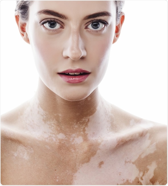 Woman with vitiligo disease