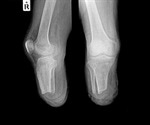 Combination of gout and diabetes carries increased risk of amputation