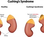 Cushing's Syndrome Diagnosis