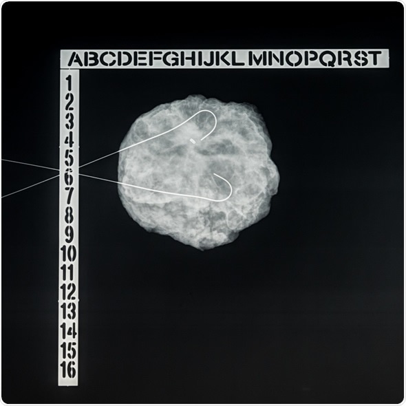 Wire-guided (needle) localization: specimen radiograph of breast biopsy (lumpectomy) for atypical ductal hyperplasia (ADH). A metallic clip marks prior biopsy site, needles bracket abnormality. Image Copyright: David Litman / Shutterstock