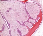Fibroadenoma Diagnosis