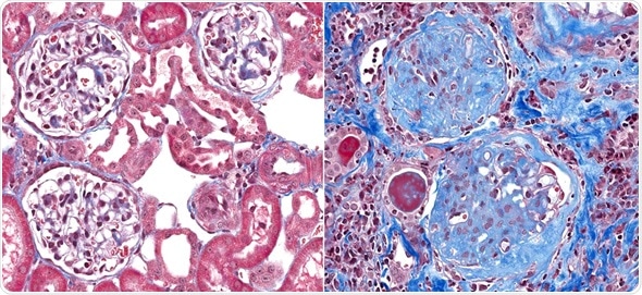 Normal healthy glomeruli (left) with glomerulosclerosis (right) a condition with fibrosis (scar) of the glomeruli (blue stain). The thin loops of blood vessels are replaced by the blue scar tissue. Image Copyright: vetpathologist / Shutterstock
