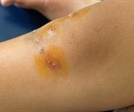 Impetigo in Babies