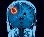 Management of Intracerebral Hemorrhage