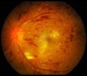 GLP-1 drugs found to protect against diabetic retinopathy