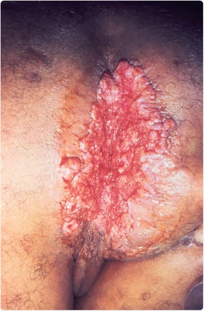 Donovanosis, otherwise known as granuloma inguinale