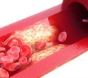 High blood pressure in adolescence can be linked to atherosclerosis risk in middle age