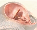 Placental Expulsion - Active vs. Physiological Management