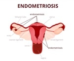 What is Endometriosis?