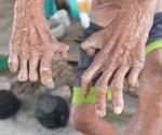 Ancient DNA sheds light on the origins of leprosy in the Americas
