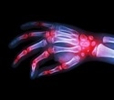 Stem-like peripheral helper T cells found to sustain inflammation in rheumatoid arthritis