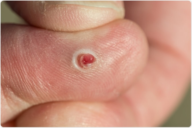Pyogenic granuloma - Image Credit: CLS Digital Arts / Shutterstock