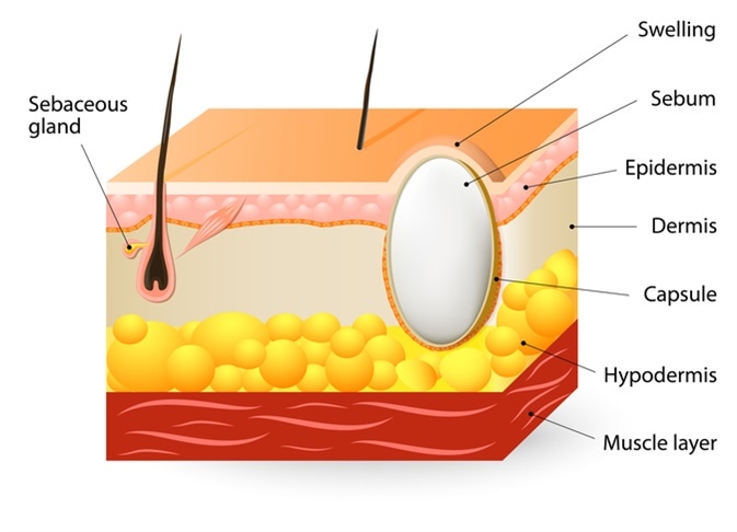 Sebaceous cysts or trichilemmal cyst. Schematic illustration of a segment of skin with Sebaceous cyst - Image Credit: Designua / Shutterstock