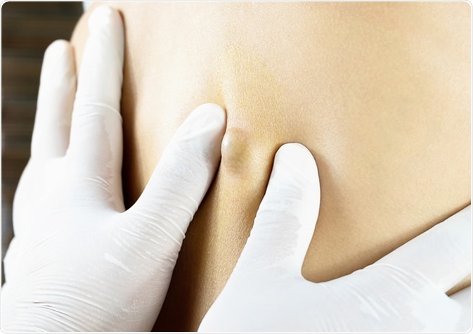 Sebaceous Cyst on Woman