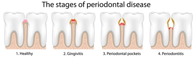 Periodontal Disease Stages - Image Credit: Alila Medical Media / Shutterstock