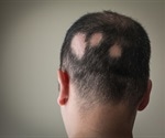 What is Alopecia?