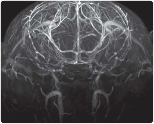 Time-of-flight angiography with no contrast agent at high spatial resolution showing excellent contrast enabling the identification of fine vascular structures