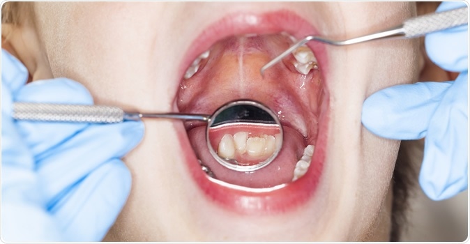 Inspection of the oral cavity dental dentist. Image Credit: Oleg Malyshev / Shutterstock