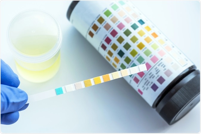 Urinalysis. Image Credit: Sirirat / Shutterstock