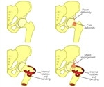 Hip Impingement Treatment