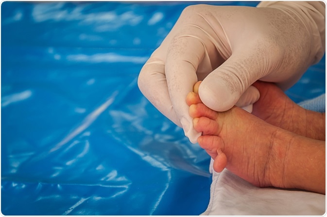 Polydactyly consist abnormal autosome in patau