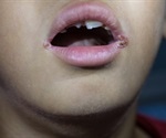 What is Angular Cheilitis?