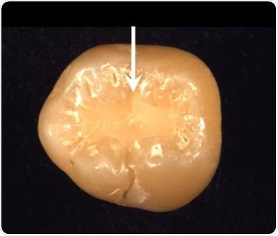 A calcium phosphate nanocomposite filling in a tooth. The nanocomposite can