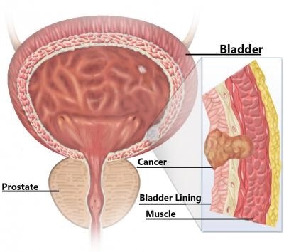 Bladder cancer is estimated to result in more than 15,000 deaths in the US in 2014. Muscle-invasive bladder cancer is the deadliest type of the disease. Image courtesy of Jonathan Bailey of the National Human Genome Research Institute