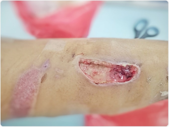 Pressure ulcer. Image Credit: Arthit Premprayot / Shutterstock