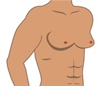 Causes of Gynecomastia