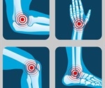 Most Common Types of Arthritis
