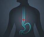 Symptoms of Esophageal Cancer