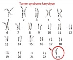 What is Turner Syndrome?