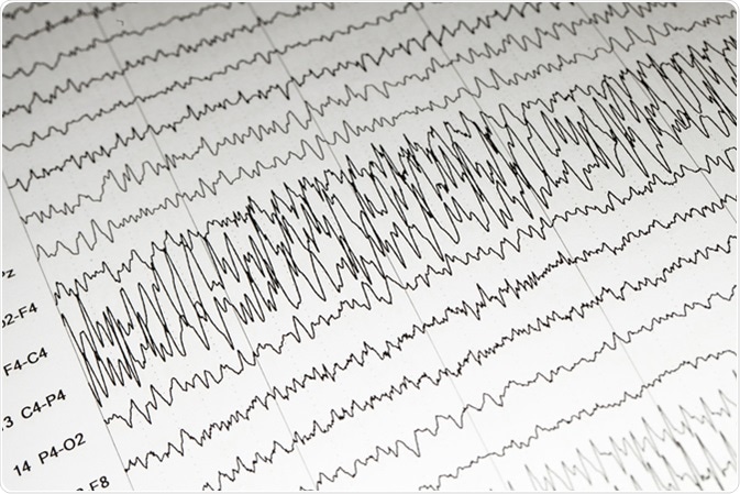 EEG wave background, Status epilepticus wave form. Image Credit: Chaikom / Shutterstock