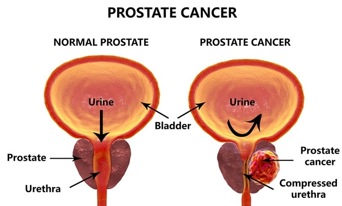 Prostate cancer, 3D illustration showing normal prostate gland and presence of tumor inside prostate gland which compresses urethra. Kateryna Kon / Shutterstock