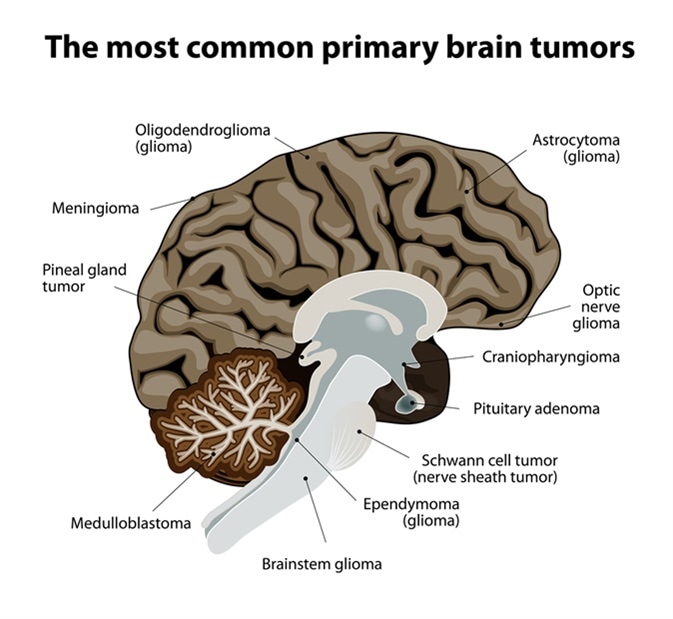 Common primary brain tumors. Image Credit: Designua / Shutterstock