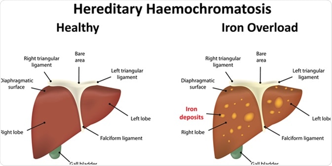 Hereditary Haemochromatosis. Image Credit: Joshya / Shutterstock