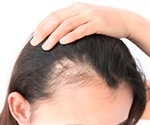 Baldness treatment using a medication for osteoporosis