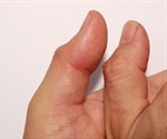Bowler's Thumb Prevention and Treatment