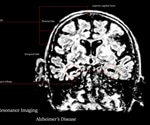 Alzheimer's Disease Prevention