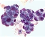 Missing cancer gene may boost response to immunotherapy