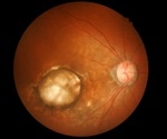 Cardiovascular risk scores predict future development of serious eye diseases